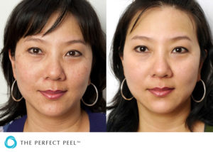 tpp_-before_and_after_02