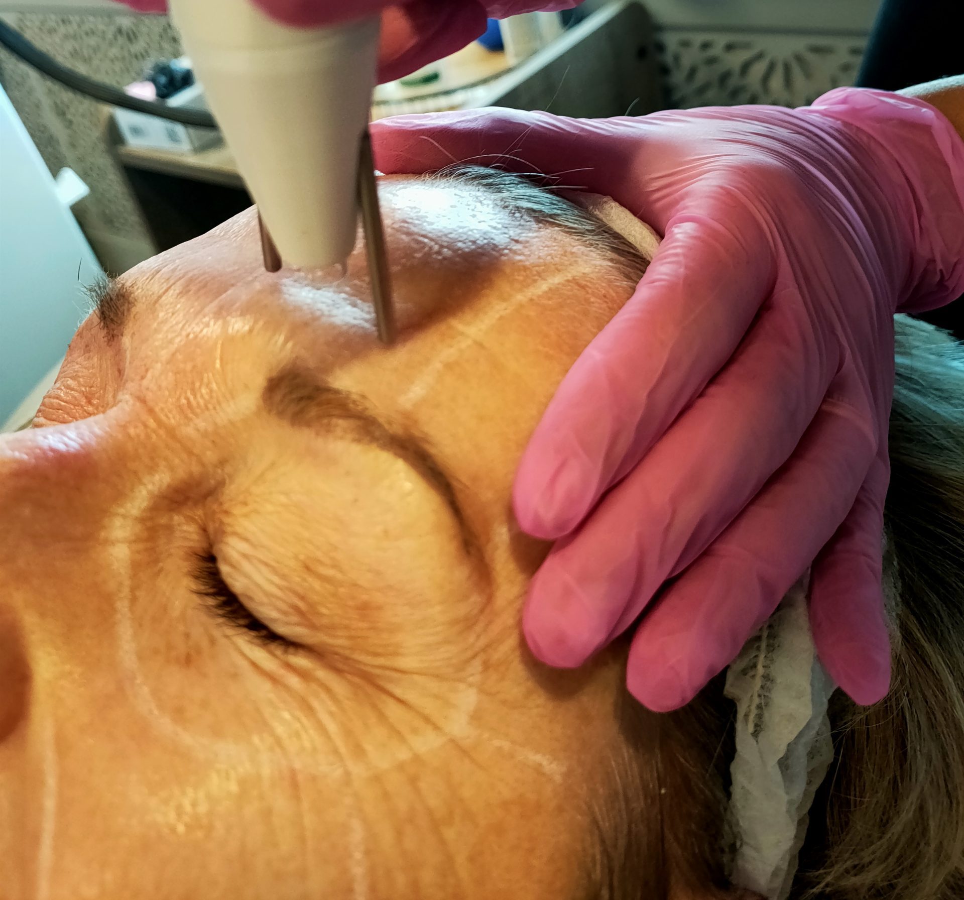 Age Jet Plasma Therapy